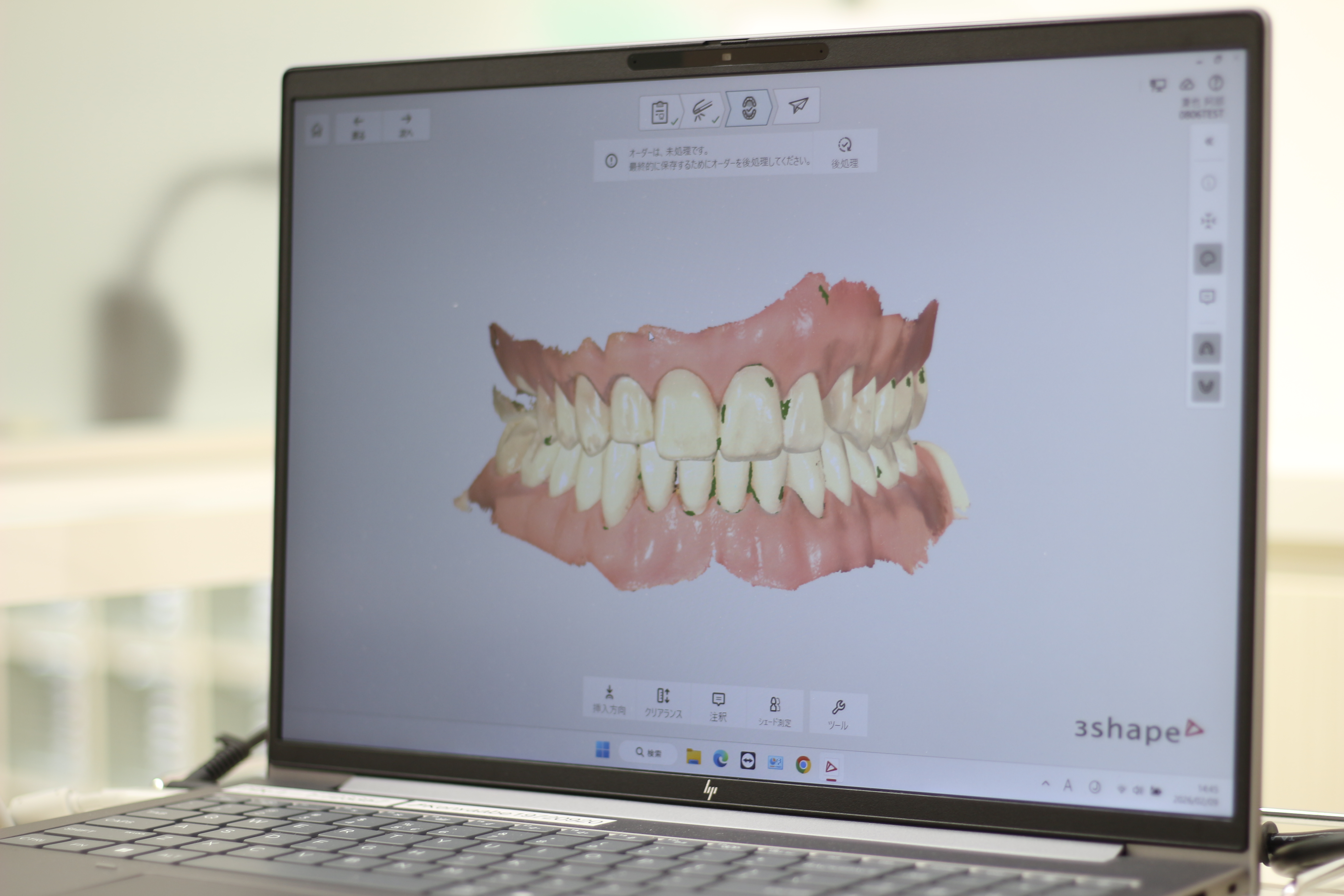 口腔内スキャナーによる3Dデータ表示